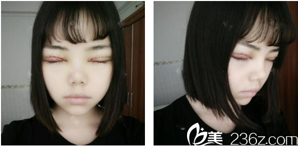 找茂名華美整形醫(yī)院<!--<i data=20240703-sp></i>-->生醫(yī)生做完雙眼皮天 找茂名華美整形醫(yī)院<!--<i data=20240703-sp></i>-->生醫(yī)生做完雙眼皮天