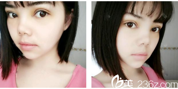 茂名華美<!--<i data=20240703-sp></i>-->生雙眼皮案例術后第三天圖片 茂名華美<!--<i data=20240703-sp></i>-->生雙眼皮案例術后第三天圖片