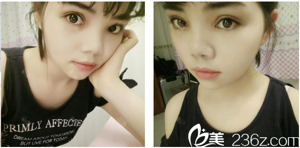 茂名華美整形醫(yī)院雙眼皮案例術后半個月自拍 茂名華美整形醫(yī)院雙眼皮案例術后半個月自拍