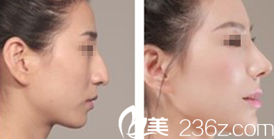 太原歐美蓮馬世理隆鼻效果對比圖