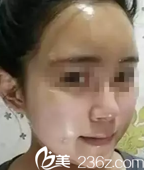 太原華美自體脂肪墊下巴豐太陽穴豐面頰術(shù)后第7天效果 太原華美自體脂肪墊下巴豐太陽穴豐面頰術(shù)后第7天效果