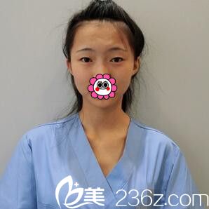 割雙眼皮術(shù)前照 割雙眼皮術(shù)前照