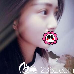 術(shù)后半個(gè)月恢復(fù)照 術(shù)后半個(gè)月恢復(fù)照