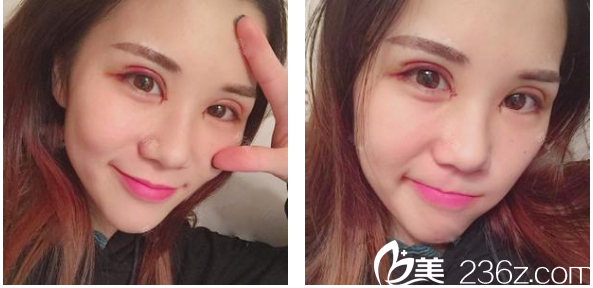 深圳<!--<i data=20240703-sp></i>-->整形科賈維順雙眼皮術(shù)后七天圖片