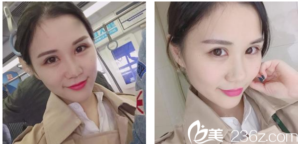 找深圳<!--<i data=20240703-sp></i>-->整形科賈維順做完雙眼皮兩周圖片