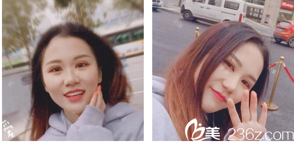 不知不覺找深圳<!--<i data=20240703-sp></i>-->賈維順做完切開雙眼皮四十天了