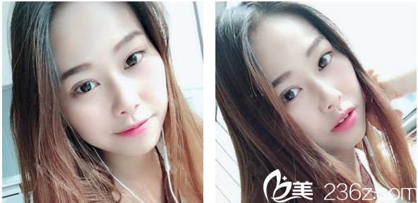 聽說我要去做隆鼻手術(shù)于是朋友推薦我去深圳博愛曙光醫(yī)院找賈維順醫(yī)生