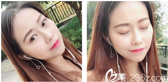 去深圳博愛整形醫(yī)院做完鼻綜合隆鼻術(shù)后一個月生活照 去深圳博愛整形醫(yī)院做完鼻綜合隆鼻術(shù)后一個月生活照