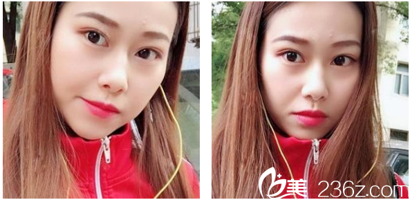 深圳博愛整形醫(yī)院賈維順鼻綜合隆鼻術(shù)后九天圖片 深圳博愛整形醫(yī)院賈維順鼻綜合隆鼻術(shù)后九天圖片