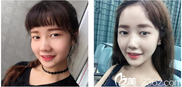 術(shù)前單眼皮照片 術(shù)前單眼皮照片