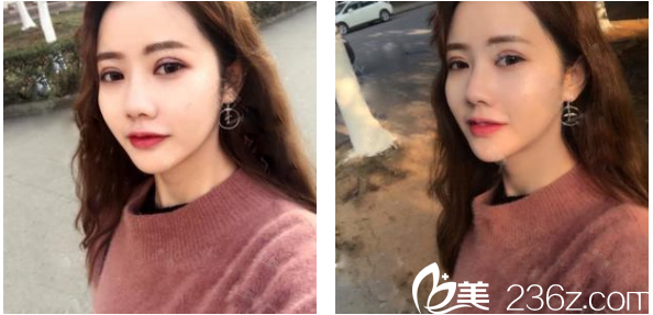 廣州壹加壹整形醫(yī)院項(xiàng)美蓮雙眼皮術(shù)后兩周恢復(fù)效果圖 廣州壹加壹整形醫(yī)院項(xiàng)美蓮雙眼皮術(shù)后兩周恢復(fù)效果圖