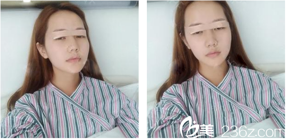 來(lái)找廣州壹加壹整形醫(yī)院做完雙眼皮第二天圖片 來(lái)找廣州壹加壹整形醫(yī)院做完雙眼皮第二天圖片