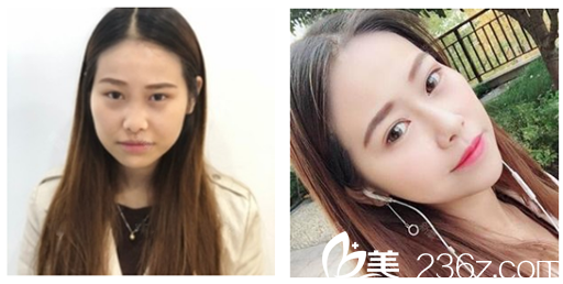 廣州壹加壹項美蓮雙眼皮<span style=