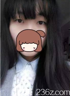 做雙眼皮術(shù)前面診 做雙眼皮術(shù)前面診