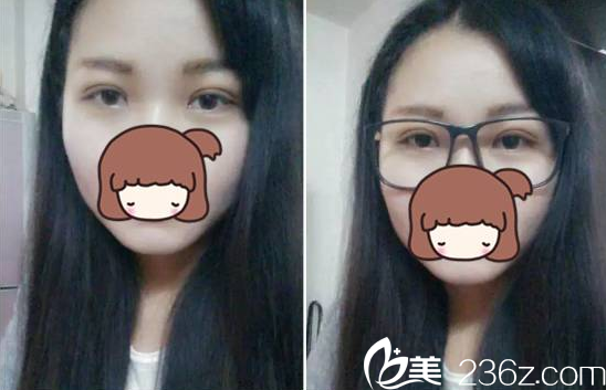 韓式雙眼皮術(shù)后一周恢復(fù) 韓式雙眼皮術(shù)后一周恢復(fù)