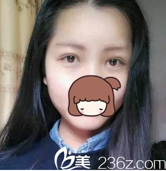 拆完線以后的雙眼皮恢復(fù) 拆完線以后的雙眼皮恢復(fù)