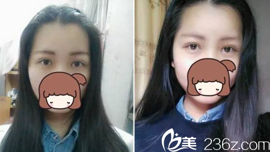 術(shù)后十天雙眼皮恢復(fù) 術(shù)后十天雙眼皮恢復(fù)