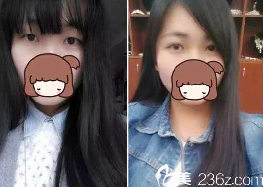 和艾菲斯都是正規(guī)醫(yī)院，恰巧預約到黃嬋院長做了韓式雙眼皮來看看效果怎么樣