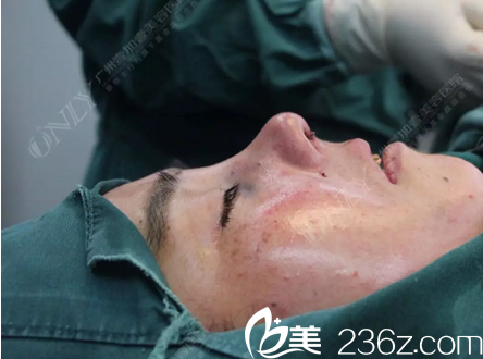 廣州壹加壹李明主任肋軟骨鼻綜合隆鼻術后即刻效果圖 廣州壹加壹李明主任肋軟骨鼻綜合隆鼻術后即刻效果圖