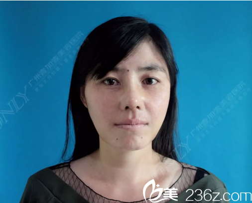 廣州壹加壹李明主任隆鼻術后十天拆線正面圖片 廣州壹加壹李明主任隆鼻術后十天拆線正面圖片