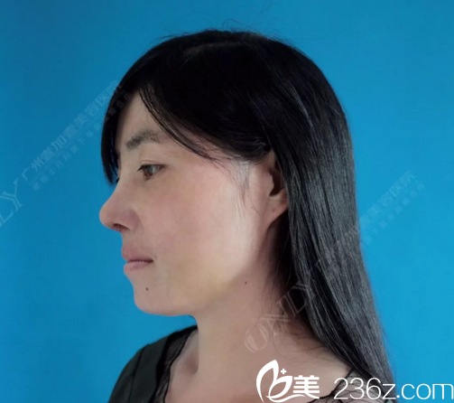 看看廣州壹加壹李明肋軟骨鼻隆鼻術后十天側(cè)面圖片 看看廣州壹加壹李明肋軟骨鼻隆鼻術后十天側(cè)面圖片