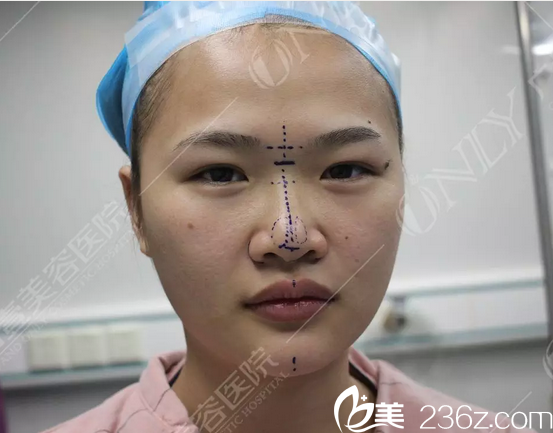 隆鼻術(shù)前正面照片來一張 隆鼻術(shù)前正面照片來一張