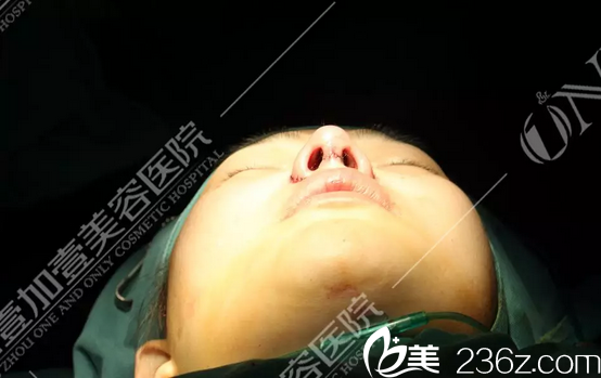 廣州壹加壹整形醫(yī)院李明隆鼻術(shù)后即刻效果圖 廣州壹加壹整形醫(yī)院李明隆鼻術(shù)后即刻效果圖