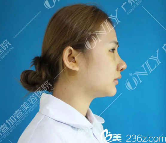 找廣州壹加壹李明主任做完隆鼻術(shù)后第三天圖片 找廣州壹加壹李明主任做完隆鼻術(shù)后第三天圖片