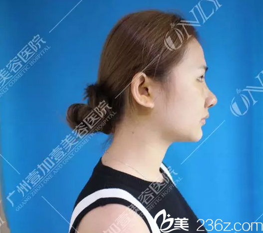 找廣州壹加壹李明主任做完隆鼻術(shù)后七天恢復(fù)情況 找廣州壹加壹李明主任做完隆鼻術(shù)后七天恢復(fù)情況