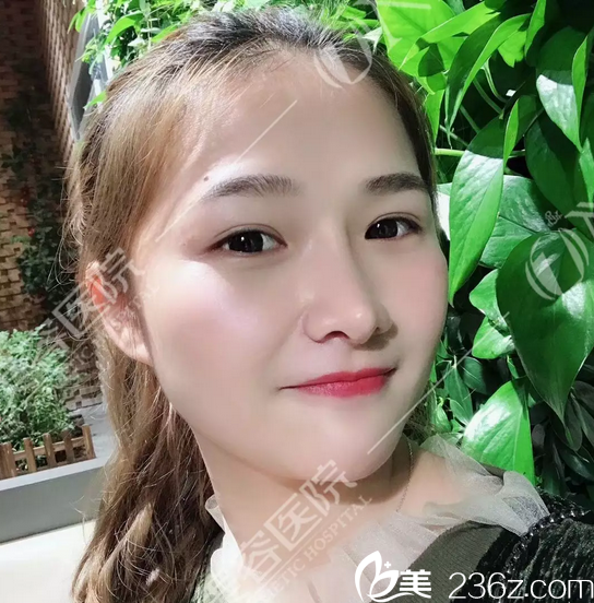 到廣州壹加壹整形醫(yī)院找李明主任做完隆鼻一個(gè)月了看我如今美成了什么樣