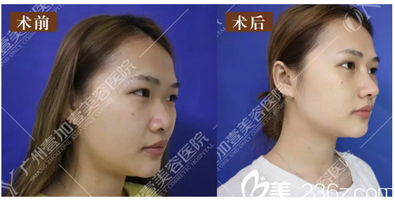 廣州壹加壹李明主任隆鼻案例對比圖 廣州壹加壹李明主任隆鼻案例對比圖