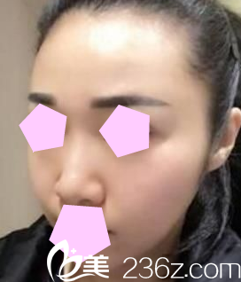 我在太原歐美蓮整形醫(yī)院做鼻綜合之前的照片 我在太原歐美蓮整形醫(yī)院做鼻綜合之前的照片