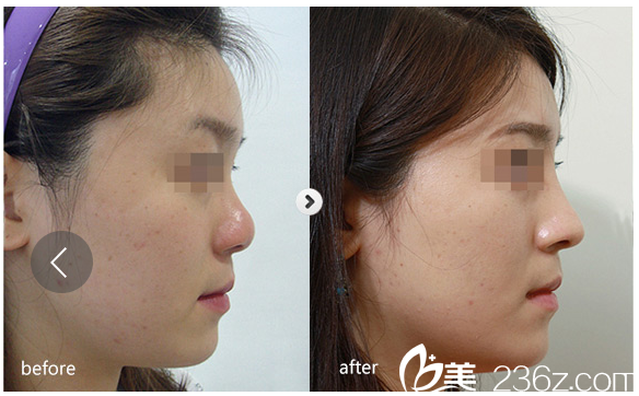 常熟時(shí)代隆鼻案例