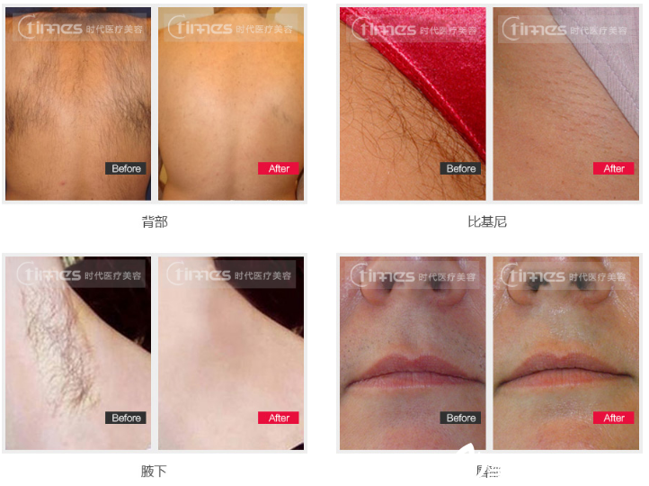 常熟時(shí)代脫毛案例