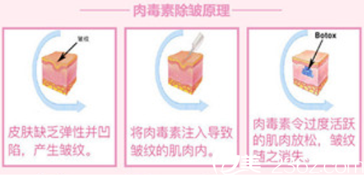 注射除皺一般多少錢？長(zhǎng)春子田瘦臉除皺注射除皺1280元/部位幫你解決皺紋