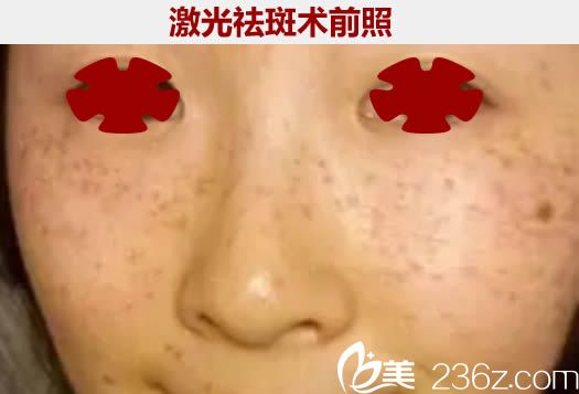 在廈門舒友千慕整形醫(yī)院做祛斑術(shù)前照 在廈門舒友千慕整形醫(yī)院做祛斑術(shù)前照