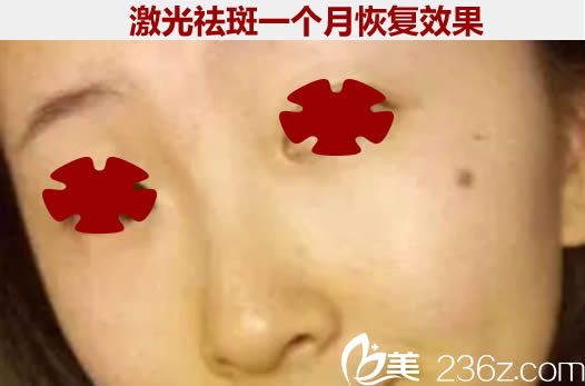 我以為廈門舒友千慕整形是傳銷呢，沒想到做完激光祛斑的第二次效果還不錯