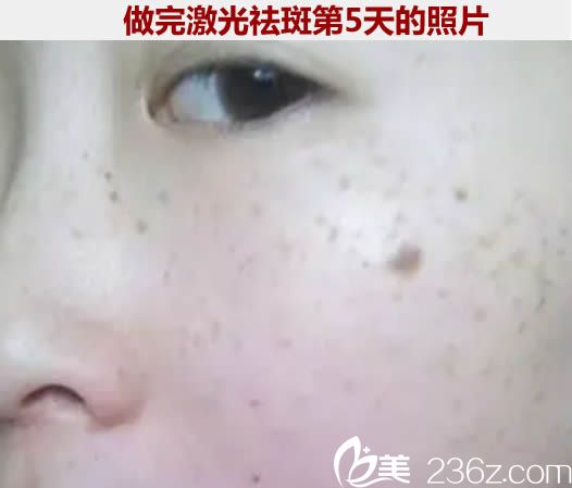 做完次激光祛斑治療5天后的照片 做完次激光祛斑治療5天后的照片