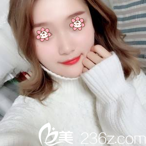 才俊明下頜角整形術(shù)后18天