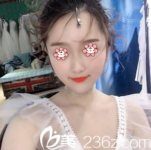 重慶光博士整形下頜角手術(shù)33天