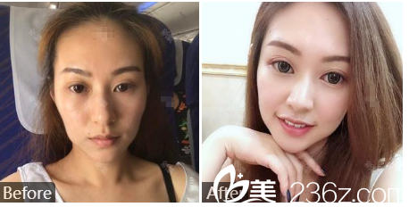 廣州廣美整形美容醫(yī)院余花面部<span style=