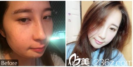 廣州廣美整形美容醫(yī)院余花自體脂肪全臉填充案例對比圖