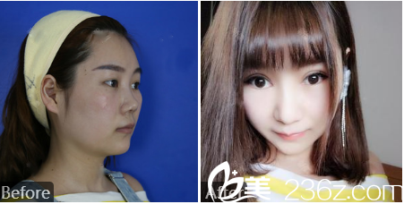 廣州廣美余花醫(yī)生雙眼皮和隆鼻案例對比圖