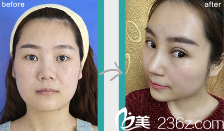 廣州廣美整形美容醫(yī)院隆鼻案例圖