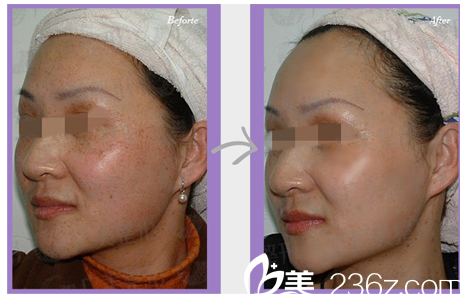 廣州廣美整形美容醫(yī)院激光祛斑案例圖