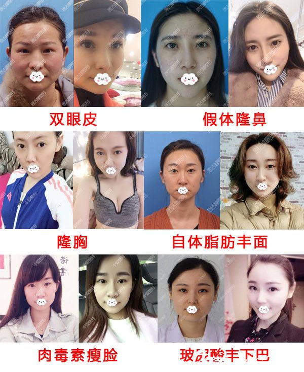 隨州奧萊整形真人案例效果對比