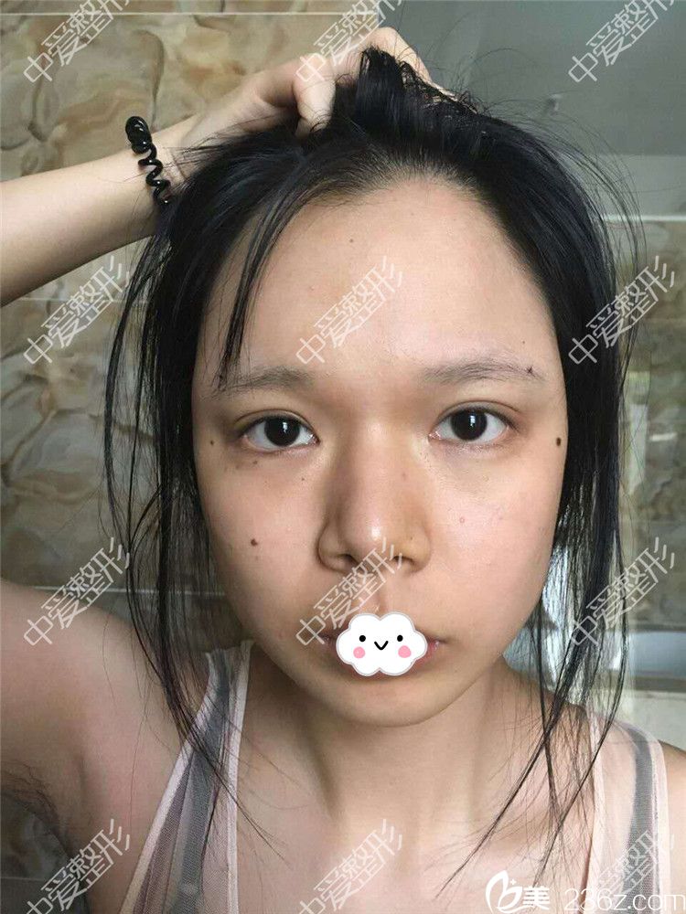 隨州奧萊<!--<i data=20240703-sp></i>-->自體脂肪豐面案例 隨州奧萊<!--<i data=20240703-sp></i>-->自體脂肪豐面案例