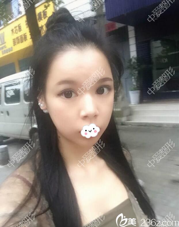 隨州奧萊<!--<i data=20240703-sp></i>-->自體脂肪面部填充真人案例 隨州奧萊<!--<i data=20240703-sp></i>-->自體脂肪面部填充真人案例