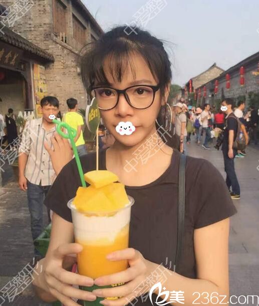 隨州奧萊<!--<i data=20240703-sp></i>-->自體脂肪填充太陽穴效果 隨州奧萊<!--<i data=20240703-sp></i>-->自體脂肪填充太陽穴效果