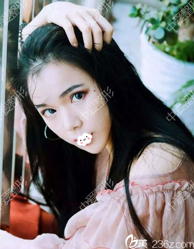 隨州奧萊自體脂肪豐面效果怎么樣 隨州奧萊自體脂肪豐面效果怎么樣